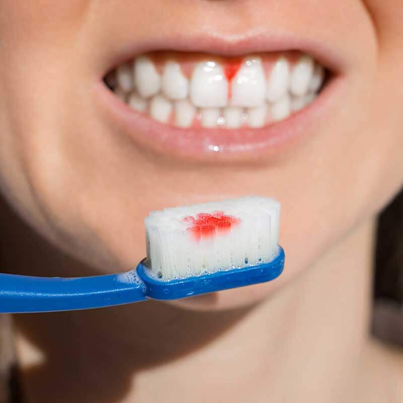 bleeding-gums