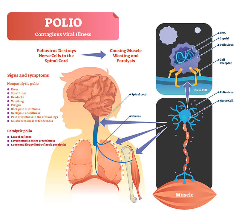 symptoms-polio