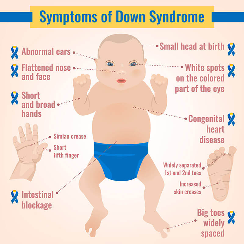 down-syndrome
