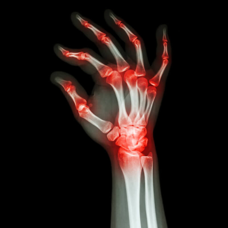 joint pain in hand