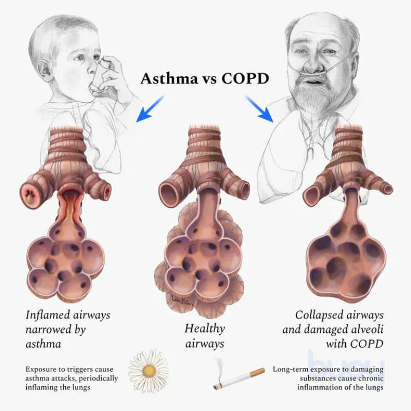 asthma vs COPD