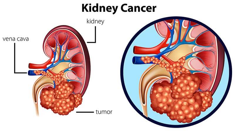 kidney-tumor