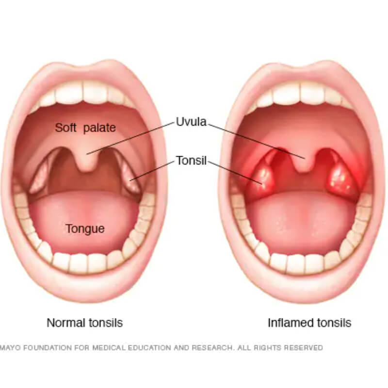 Image of Tonsillitis and normal tonsils