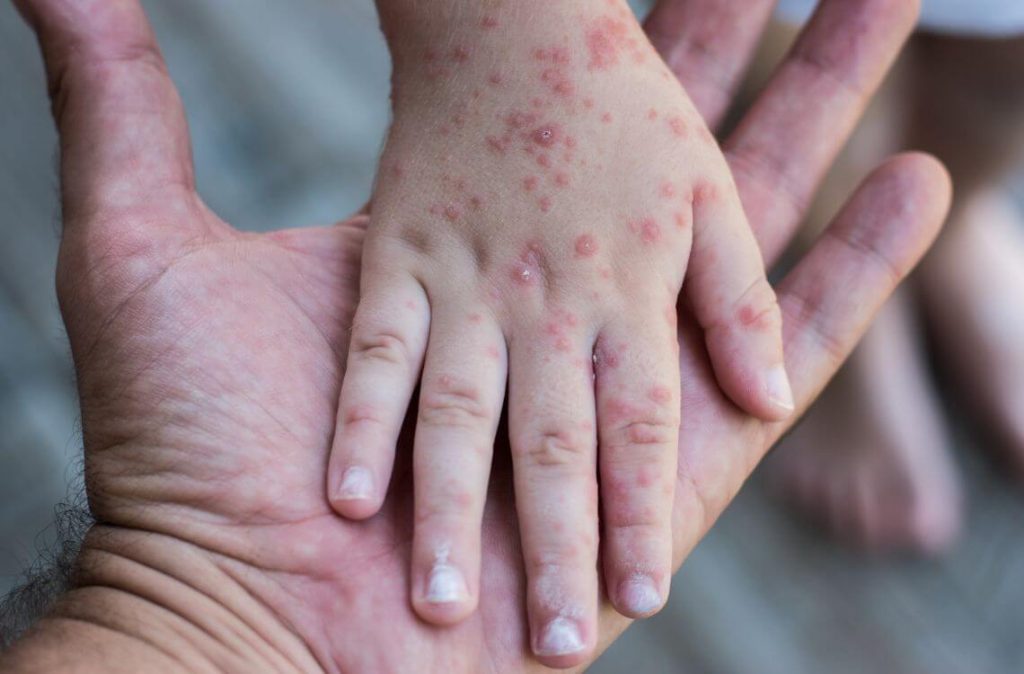 hand-foot-and-mouth-disease