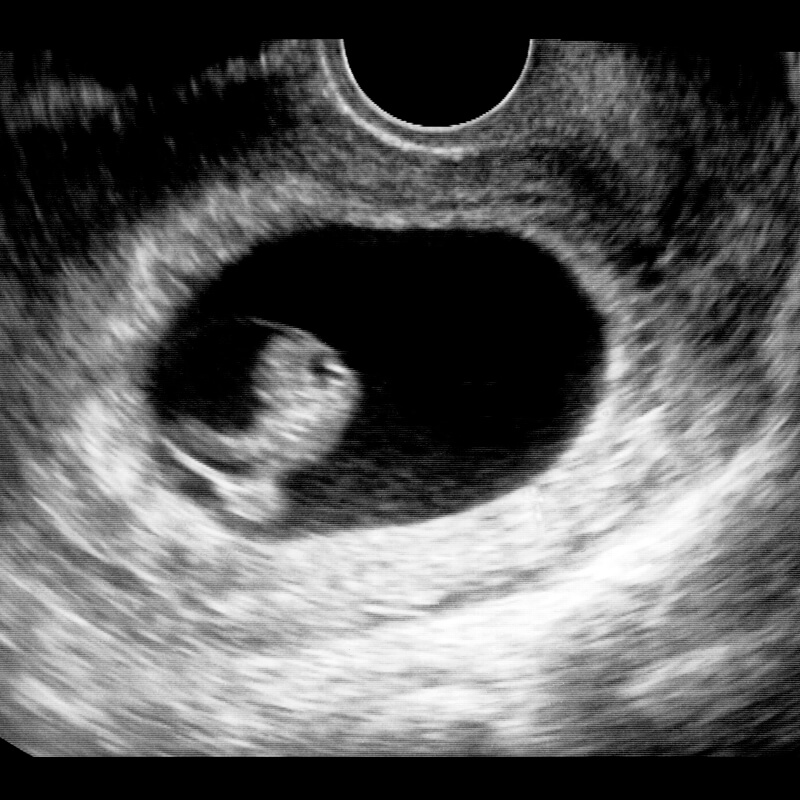 Ultrasound scan