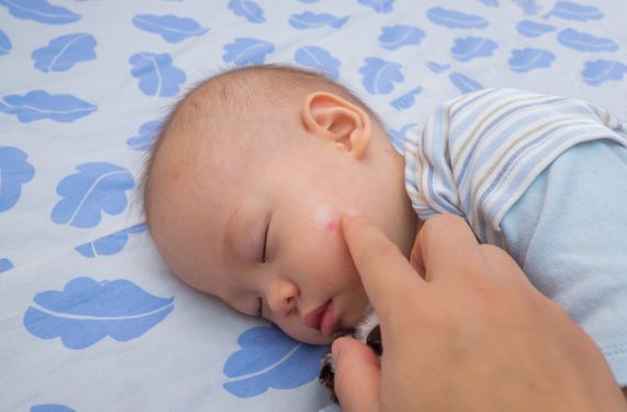 Mosquito Bites on Babies