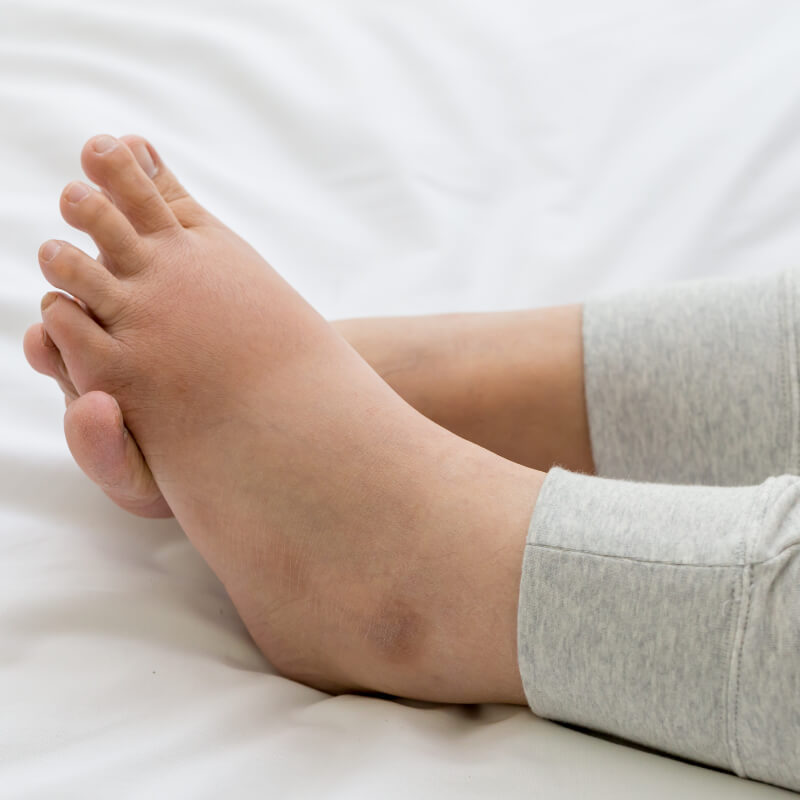 swollen feet during third trimester