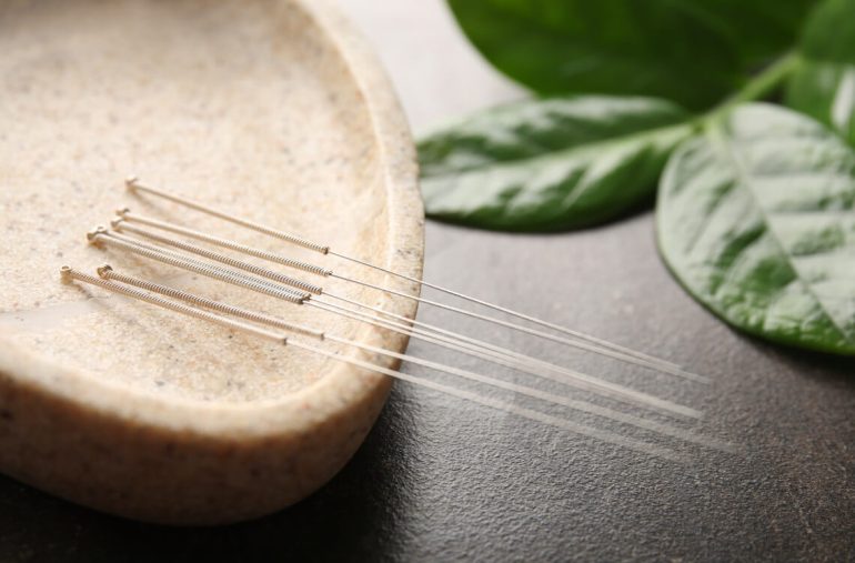 Benefits of Acupuncture during Pregnancy