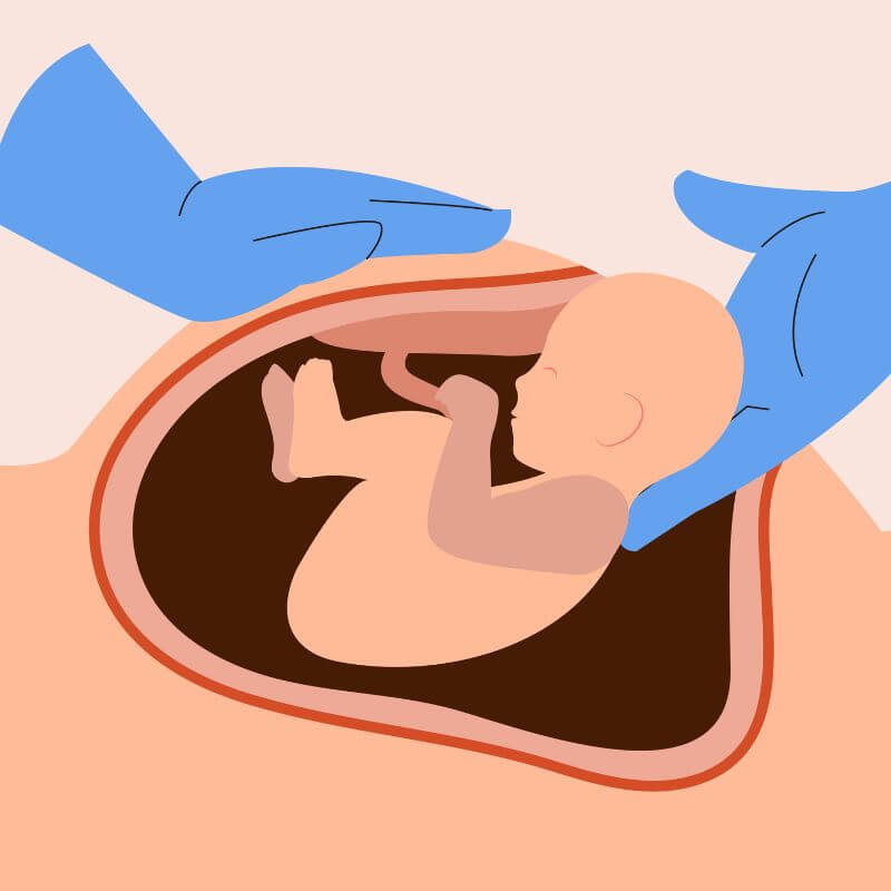 baby-birth-c-section
