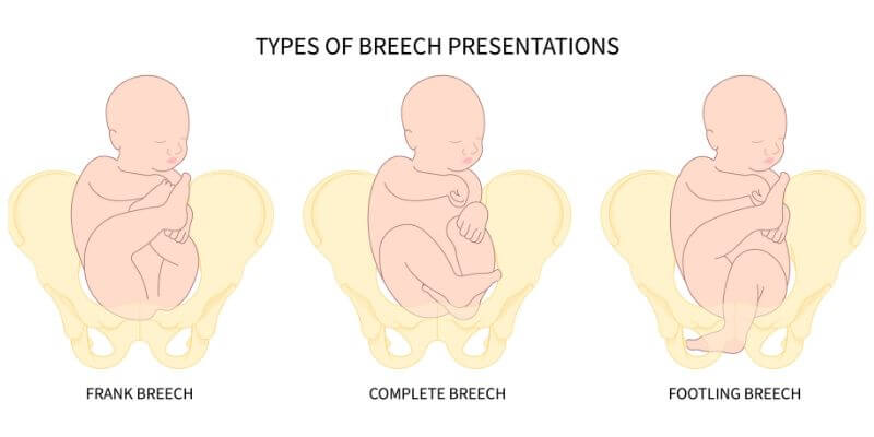 pregnancy-breech