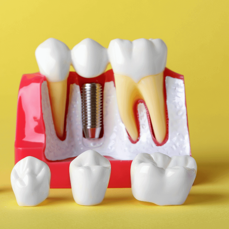 Crown to Solve Cavities