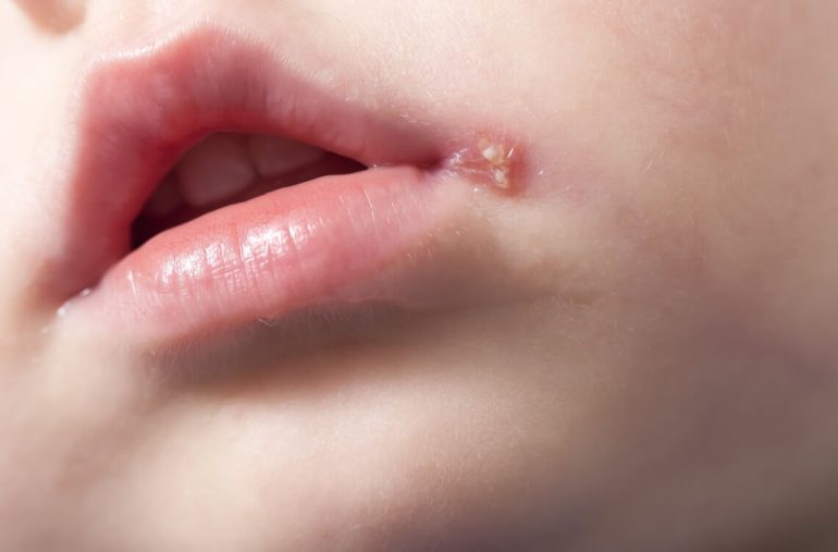 ulcer-cold-sore