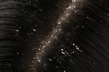 dandruff4 (1)