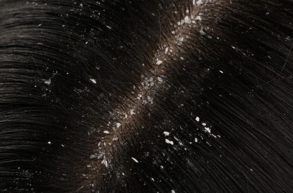 dandruff4 (1)