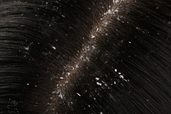 dandruff4 (1)