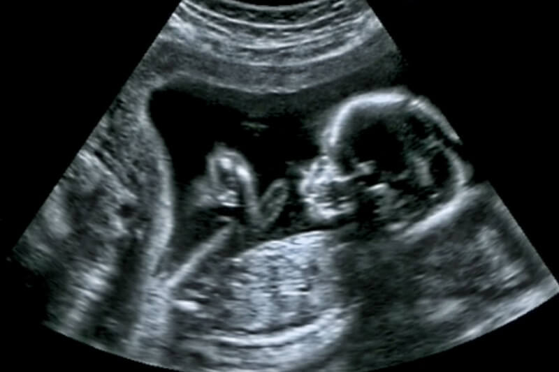 ultrasound1