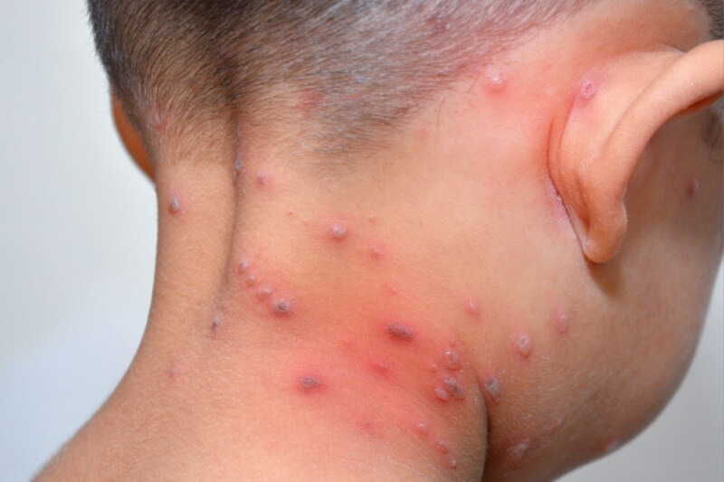 chickenpox1