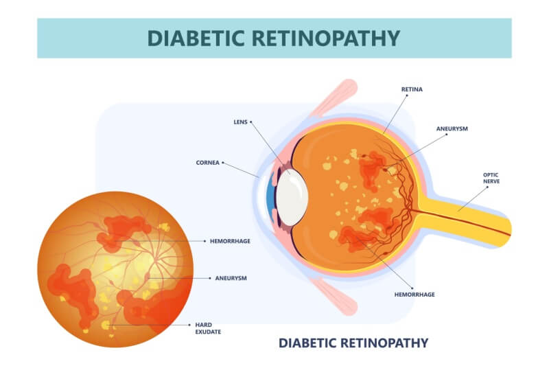 retinopathy