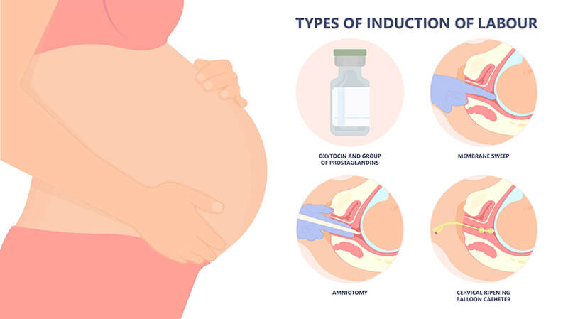 types of induction of labour