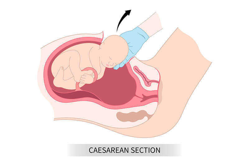 c-section