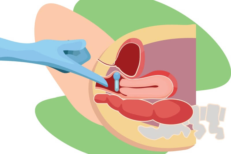 pessary-incontinence