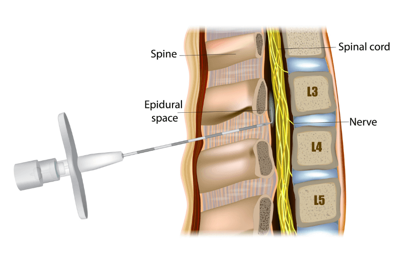 epidural needle