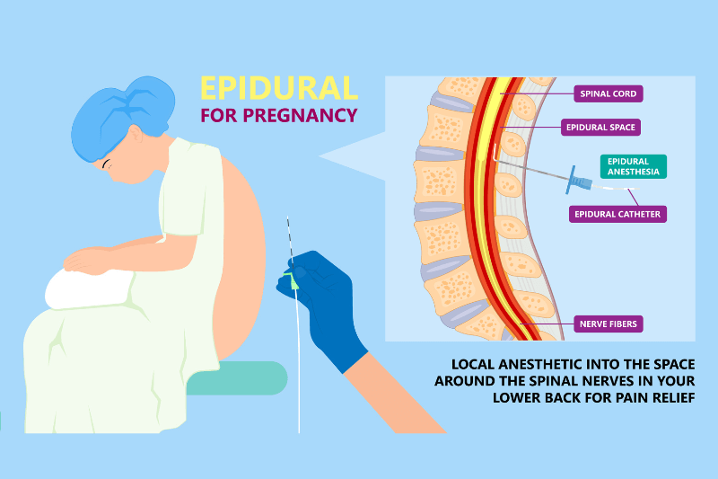 how does the epidural procedure work