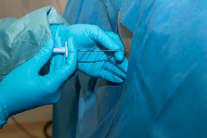 epidural anaesthesia