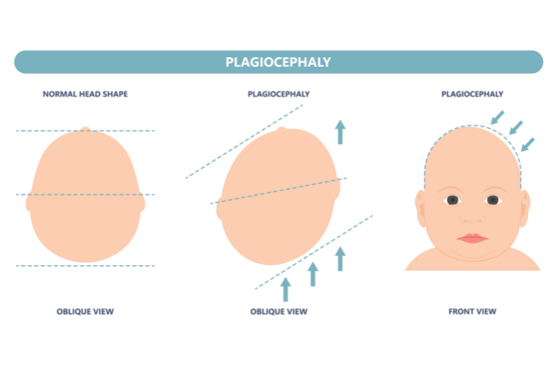 plagiocephaly