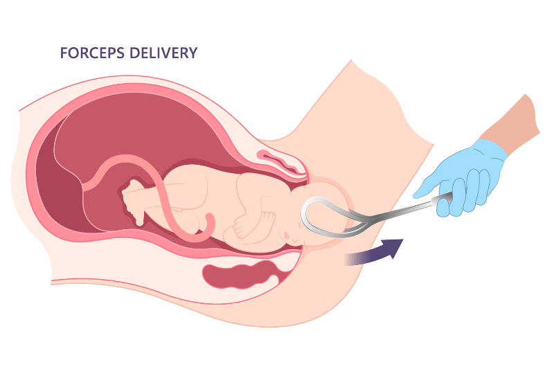 forceps delivery