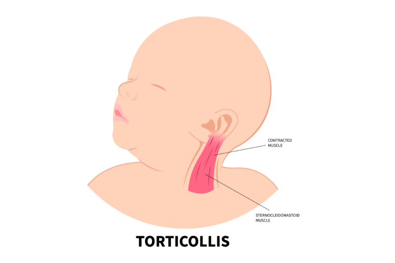 torticollis