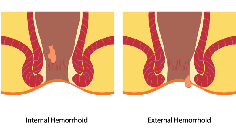 types of haemorrhoids