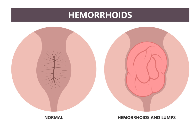 haemorrhoids swelling