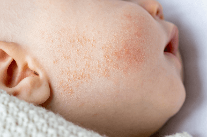 baby acne