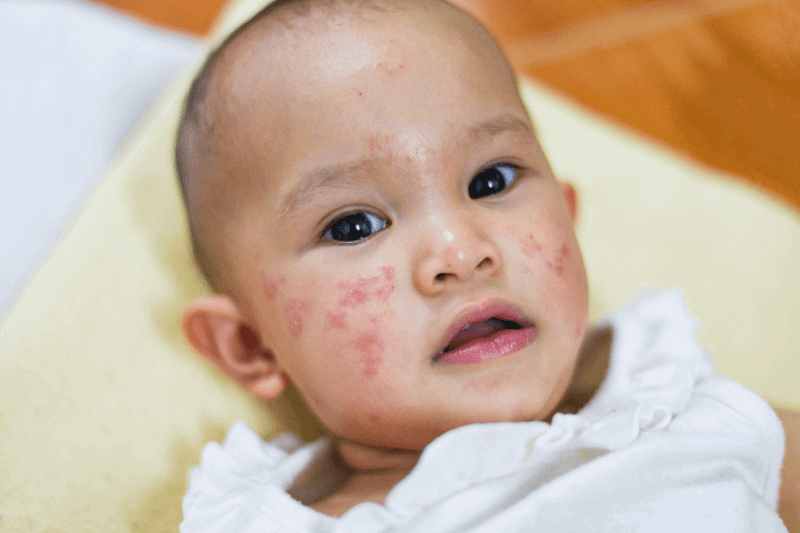 severe baby acne