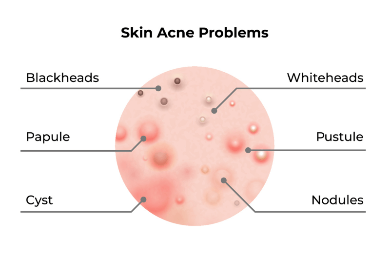 skin acne problems