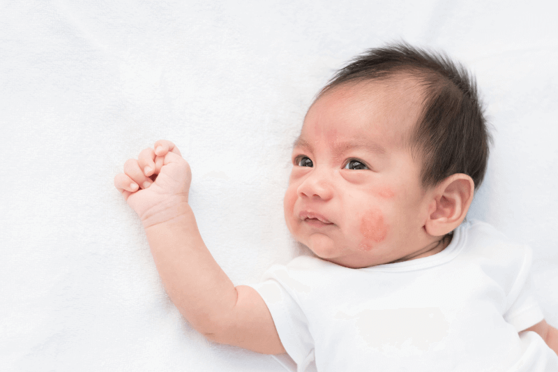 baby eczema