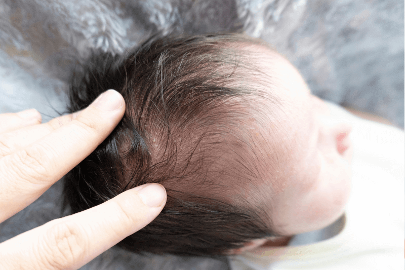 cradle cap