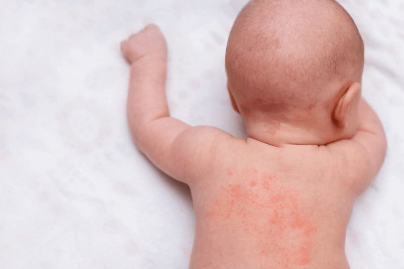 heat rash miliaria