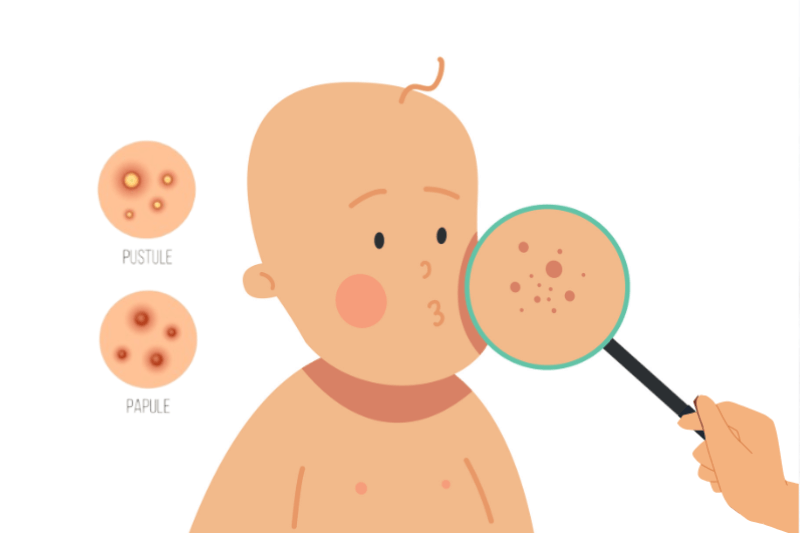 identifying baby acne