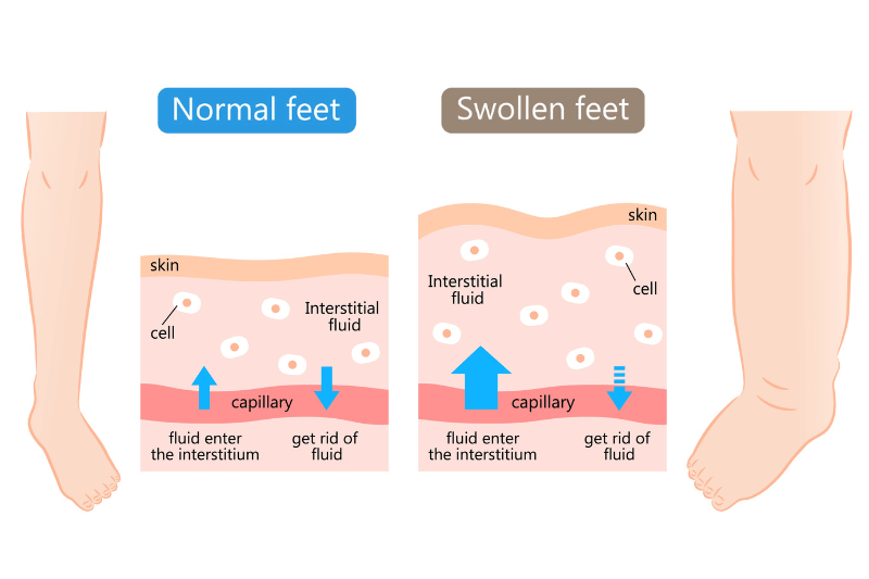 oedema fluid retention