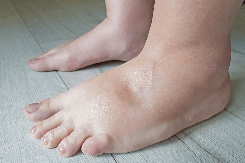 oedema ankles and feet