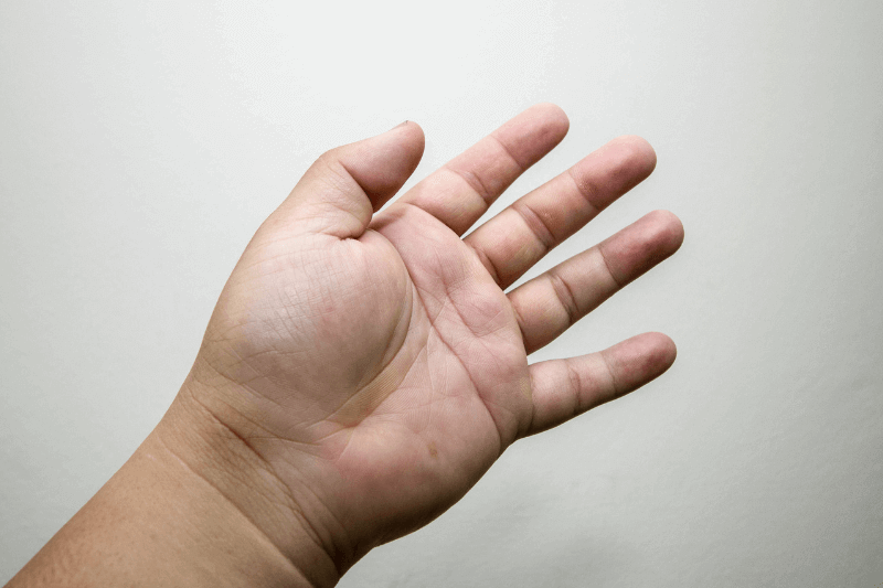 swollen hands