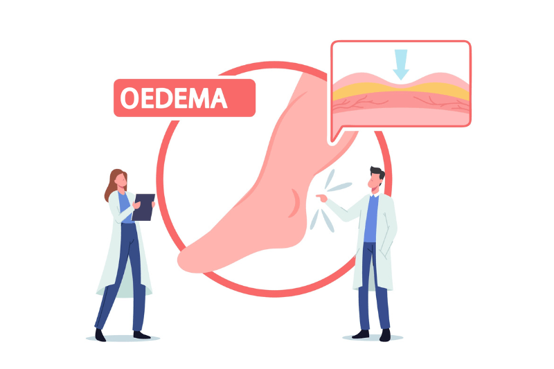 tips to reduce oedema swelling