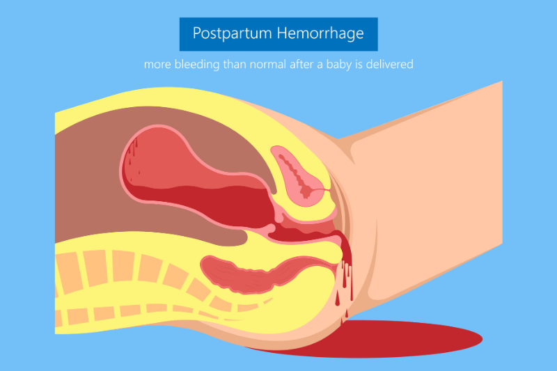 postpartum haemorrhage