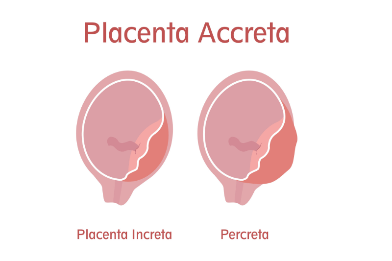 placental accreta