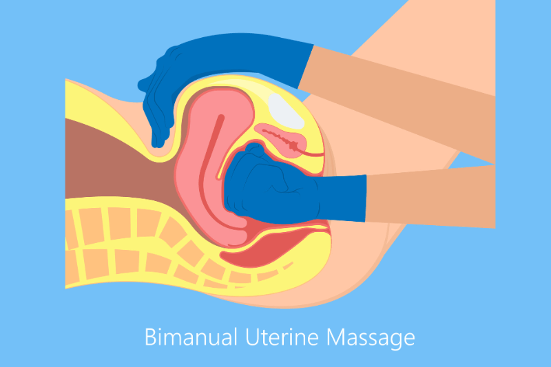 postpartum haemorrhage