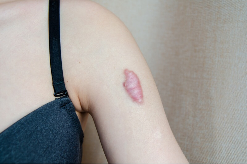 keloid scar on womans arm