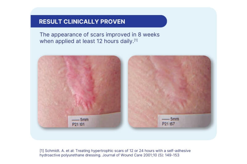 scar improvement from treatment