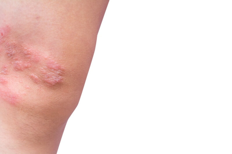 psoriasis psoriasis-5